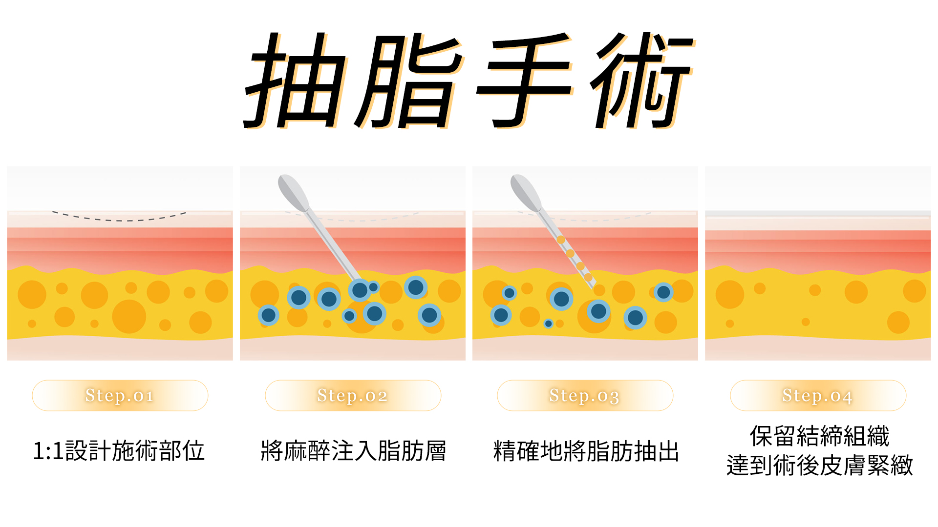 抽脂常見問題