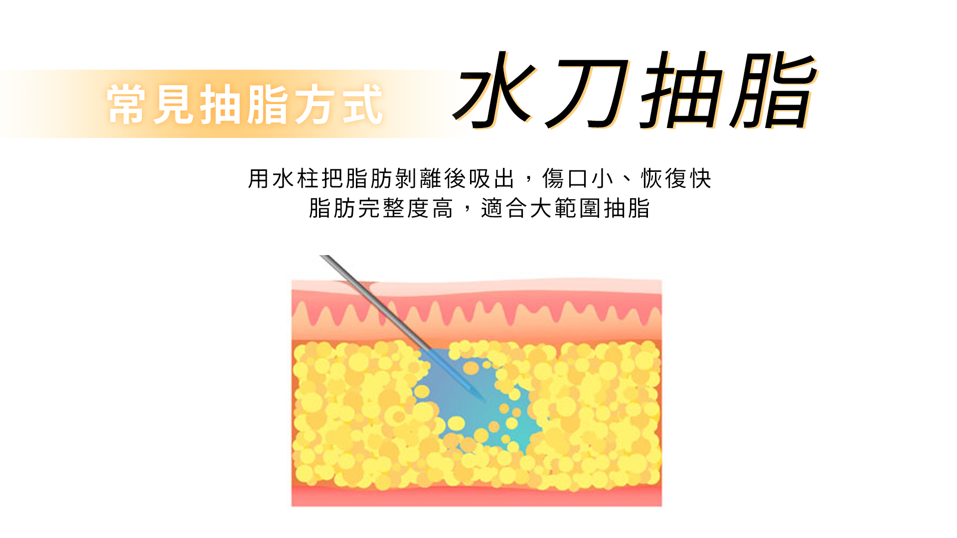 水刀抽脂