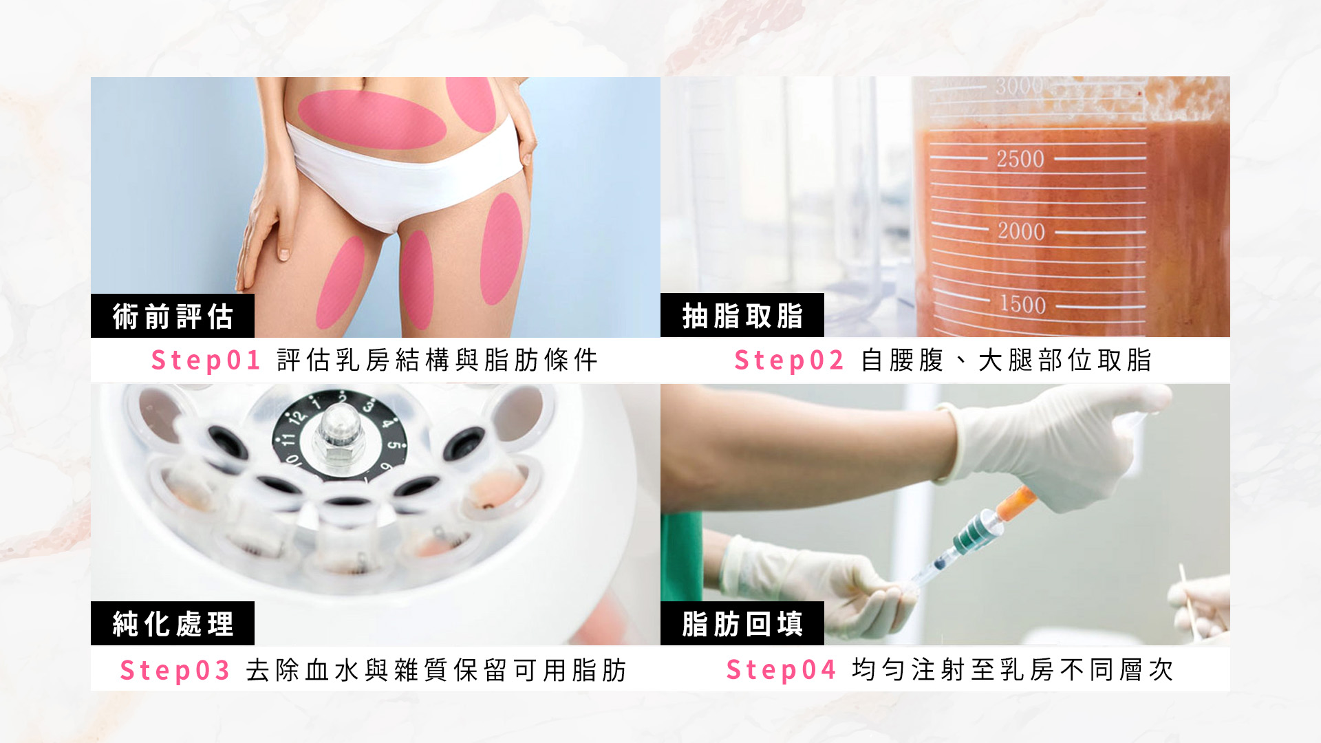 台南自體脂肪隆乳手術流程